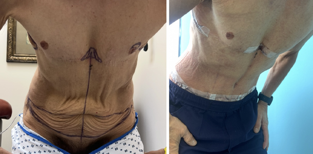 abdominoplasty 3.JPG