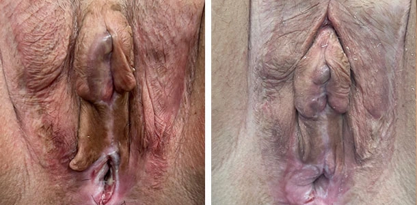 labiaplasty-003