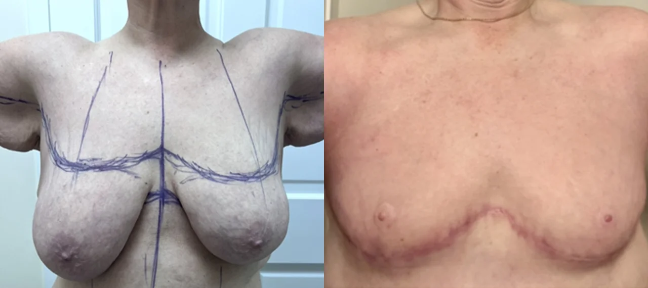 top and arm surgery-3