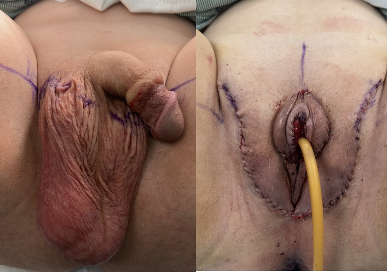 vaginoplasty 1