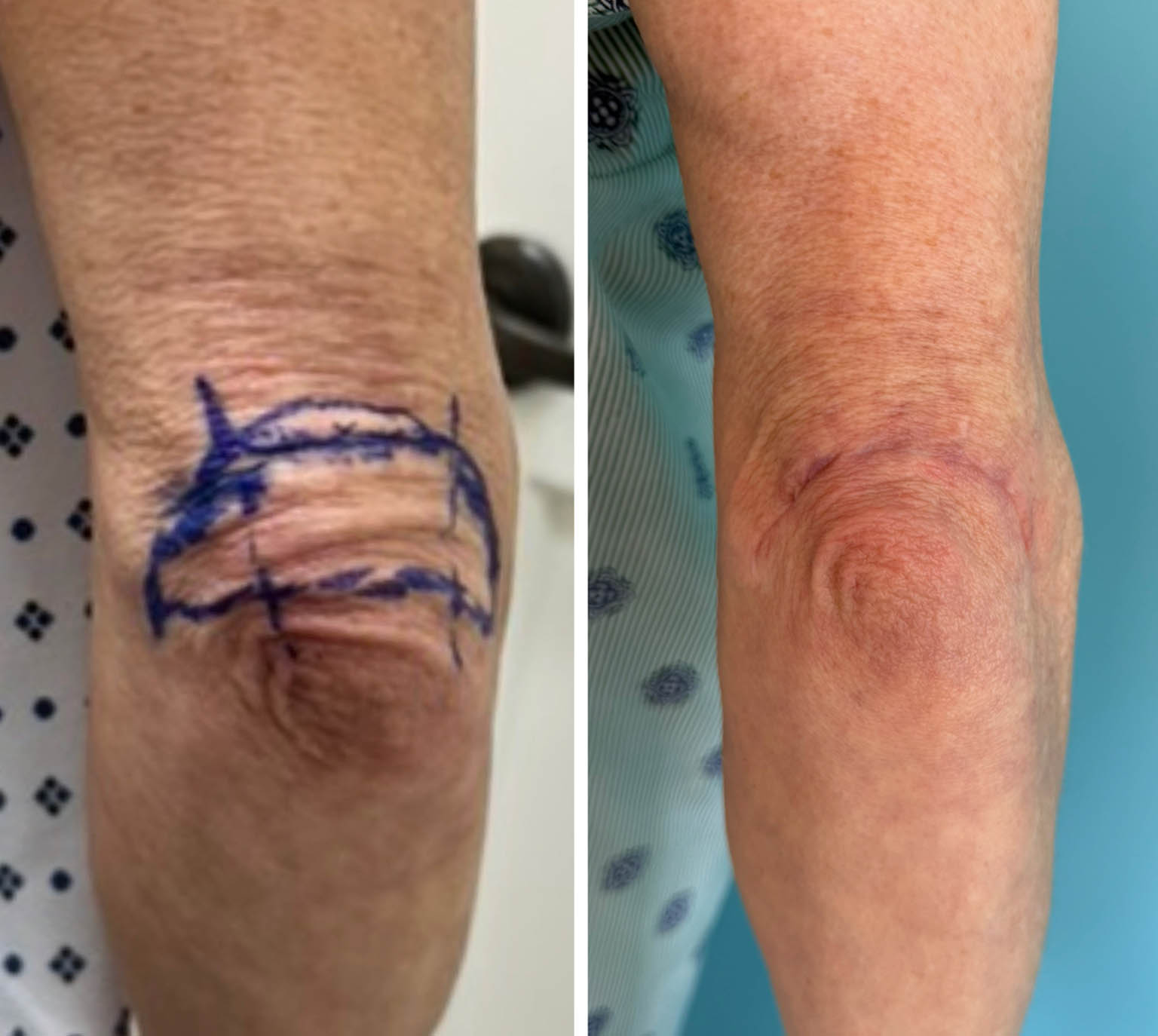 1_0009_Elbow marking 1.JPG