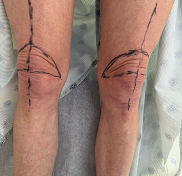 Knee markings 1.HEIC