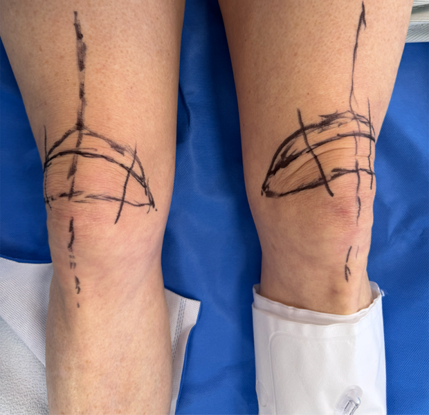 Knee markings 2 .HEIC