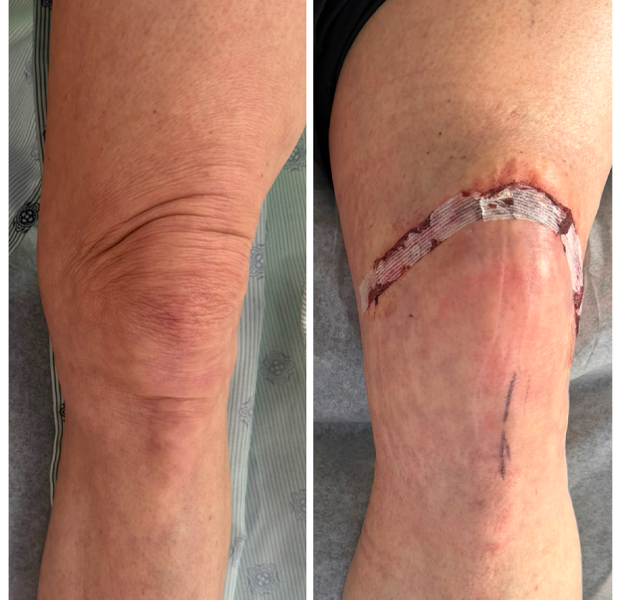 bilateral knee