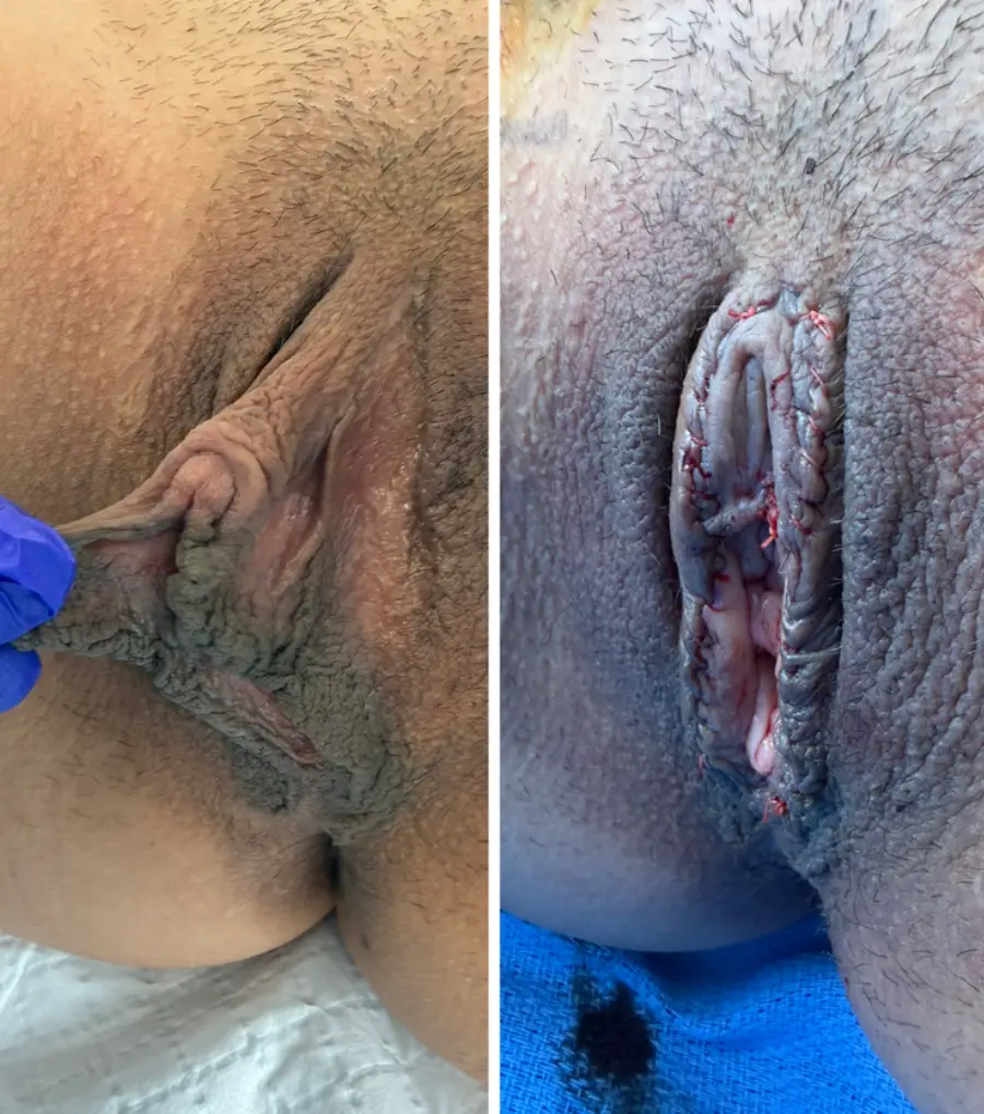clitoris-redution-labiaplasty (2)