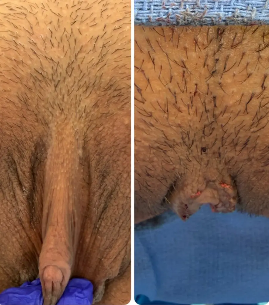 clitoris-redution-labiaplasty