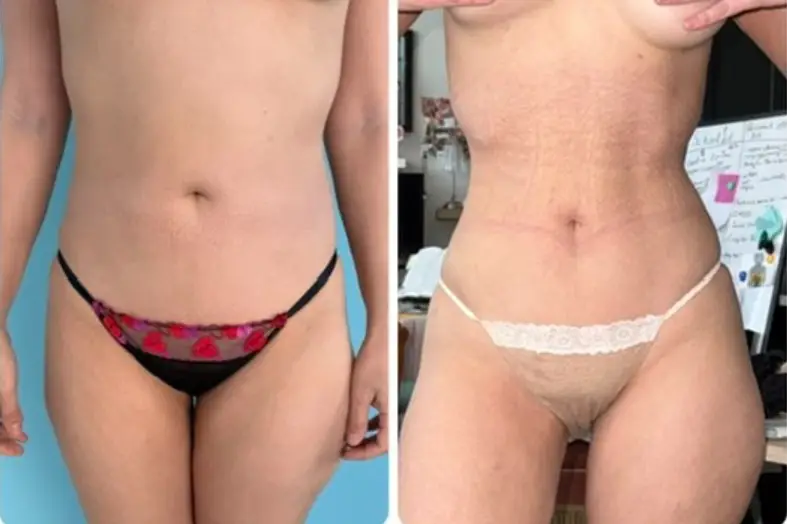 rib-remodeling-pat1